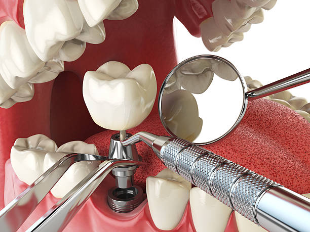 Best Emergency Wisdom Tooth Extraction in Loyola, CA